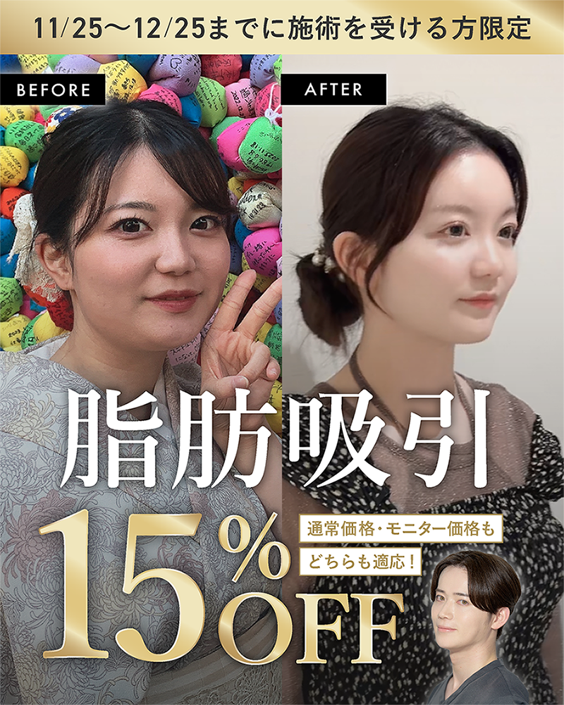 【脂肪吸引】15%OFFキャンペーン開始📢✨